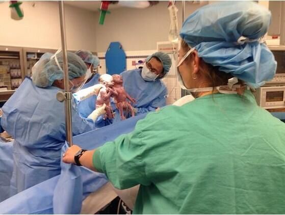 Ретки комплети близанаца 'Моно Моно' држе руке неколико тренутака након рођења